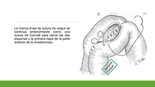 La misma línea de sutura de catgut se
continua anteriormente como una
sutura de Connell para cerrar las dos
esquinas y la primera capa de la parte
anterior de la anastomosis.
 