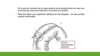 En la porción anterior de la capa externa de la anastomosis se hace con
una línea de sutura de seda de 4-0 puntos de Lembert.
Para las áreas que requieren refuerzo en los ángulos , se dan puntos
sueltos adicionales.
Cierre
seromuscular
anterior
 