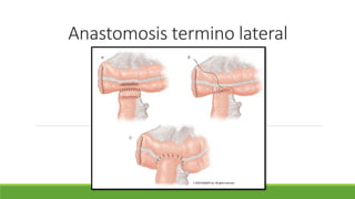 Anastomosis termino lateral
 