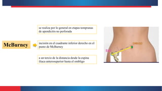 McBurney
se realiza por lo general en etapas tempranas
de apendicitis no perforada
incisión en el cuadrante inferior derecho en el
punto de McBurney
a un tercio de la distancia desde la espina
iliaca anterosuperior hasta el ombligo
 