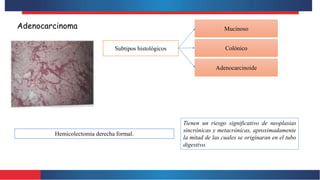 Adenocarcinoma
Subtipos histológicos
Mucinoso
Adenocarcinoide
Colónico
Hemicolectomia derecha formal.
Tienen un riesgo significativo de neoplasias
sincrónicas y metacrónicas, aproximadamente
la mitad de las cuales se originaran en el tubo
digestivo.
 
