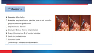Tratamiento
 Resección del apéndice
 Resección amplia del meso apéndice para incluir todos los
ganglios linfáticos apendiculares
 Exploración del derrame
 Citológico de todo el moco intraperitoneal
 Inspección minuciosa de la base del apéndice.
 Hemicolectomia derecha
 Ileocequectomia
 Quimioterapia intraperitoneal hipertérmica.
 