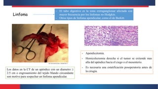 Linfoma
- El tubo digestivo es la zona extraganglionar afectada con
mayor frecuencia por los linfomas no Hodgkin.
- Otros tipos de linfoma apendicular, como el de Burkitt.
Los datos en la CT de un apéndice con un diametro ≥
2.5 cm o engrosamiento del tejido blando circundante
son motivo para sospechar un linfoma apendicular.
- Apendicetomía.
- Hemicolectomia derecha si el tumor se extiende mas
alla del apéndice hacia el ciego o el mesenterio.
- Es necesaria una estatificación posoperatoria antes de
la cirugía.
 