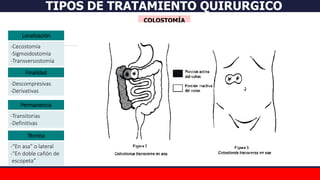 COLOSTOMÍA
TIPOS DE TRATAMIENTO QUIRURGICO
Localización
Permanencia
Finalidad
Técnica
-“En asa” o lateral
-“En doble cañón de
escopeta”
-Descompresivas
-Derivativas
-Cecostomía
-Sigmoidostomía
-Transversostomía
-Transitorias
-Definitivas
 