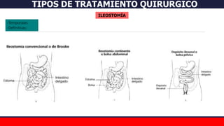 TIPOS DE TRATAMIENTO QUIRURGICO
ILEOSTOMÍA
-Temporales
-Definitivas:
 