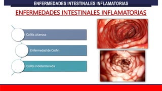 ENFERMEDADES INTESTINALES INFLAMATORIAS
Colitis ulcerosa
Enfermedad de Crohn
Colitis indeterminada
ENFERMEDADES INTESTINALES INFLAMATORIAS
 