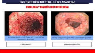 Colitis ulcerosa Enfermedad de Crohn
La mucosa puede ser atrófica y con frecuencia hay
abscesos en las criptas.
Úlceras serpiginosas profundas y aspecto en “guijarros”
ENFERMEDADES INTESTINALES INFLAMATORIAS
PATOLOGÍA Y DIAGNÓSTICO DIFERENCIAL
 