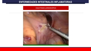 COLECTOMIA LAPAROSCÓPICA
ENFERMEDADES INTESTINALES INFLAMATORIAS
 