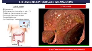  Laboratorio
 Toma de muestras de heces (para CD)
 Radiografía simple de abdomen
 Tomografía computarizada
 Sigmoidoscopía
 Colonoscopia sin sobrepasar recto
https://www.youtube.com/watch?v=Ya9LXBs6jPk
ENFERMEDADES INTESTINALES INFLAMATORIAS
DIAGNÓSTICO COLONOSCOPIA
 