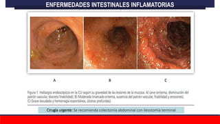 ENFERMEDADES INTESTINALES INFLAMATORIAS
Cirugía urgente: Se recomienda colectomía abdominal con ileostomía terminal
 