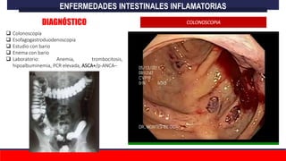  Colonoscopía
 Esofagogastroduodenoscopia
 Estudio con bario
 Enema con bario
 Laboratorio: Anemia, trombocitosis,
hipoalbuminemia, PCR elevada, ASCA+/p-ANCA–
ENFERMEDADES INTESTINALES INFLAMATORIAS
DIAGNÓSTICO COLONOSCOPIA
 