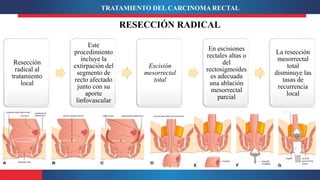 Resección
radical al
tratamiento
local
Este
procedimiento
incluye la
extirpación del
segmento de
recto afectado
junto con su
aporte
linfovascular
Escisión
mesorrectal
total
En escisiones
rectales altas o
del
rectosigmoides
es adecuada
una ablación
mesorrectal
parcial
La resección
mesorrectal
total
disminuye las
tasas de
recurrencia
local
RESECCIÓN RADICAL
TRATAMIENTO DEL CARCINOMA RECTAL
 