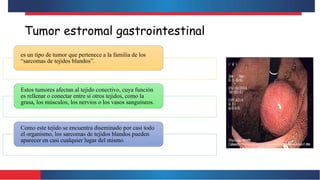 Tumor estromal gastrointestinal
es un tipo de tumor que pertenece a la familia de los
“sarcomas de tejidos blandos”.
Estos tumores afectan al tejido conectivo, cuya función
es rellenar o conectar entre sí otros tejidos, como la
grasa, los músculos, los nervios o los vasos sanguíneos.
Como este tejido se encuentra diseminado por casi todo
el organismo, los sarcomas de tejidos blandos pueden
aparecer en casi cualquier lugar del mismo.
 