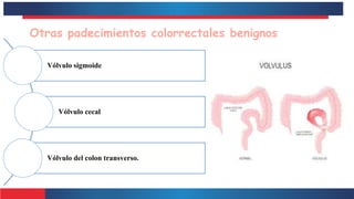 Otras padecimientos colorrectales benignos
Vólvulo sigmoide
Vólvulo cecal
Vólvulo del colon transverso.
 