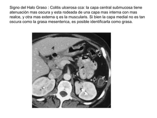 Signo del Halo Graso : Colitis ulcerosa cca: la capa central submucosa tiene
atenuaciòn mas oscura y esta rodeada de una c...