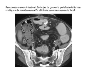 Pseudoneumatosis intestinal: Burbujas de gas en la perisferia del lumen
contiguo a la pared colonica.En el interior se obs...