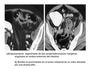 a)Engrosamiento segmentado de tipo anular(adenoca)con margenes
       angulosos en ambos extremos del intestino.

       B...