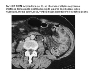 TARGET SIGN: Angioedema del ID, se observan mùtliples segmentos
afectados demostrando engrosamiento de la pared con 3 capa...