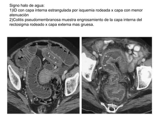 Signo halo de agua:
1)ID con capa interna estrangulada por isquemia rodeada x capa con menor
atenuaciòn
2)Colitis pseudome...
