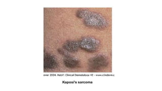 Disorder of the skin…
III. fungal infections
– Candidiasis
– Tinea captis
– Tinea corporis
– Tinea pedis (atlet's foot)
 