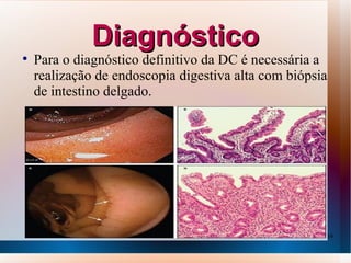 Diagnóstico

    Para o diagnóstico definitivo da DC é necessária a
    realização de endoscopia digestiva alta com biópsia
    de intestino delgado.




                                                      16
 