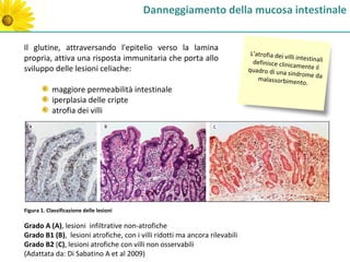 Danneggiamento della mucosa intestinale


Il glutine, attraversando l'epitelio verso la lamina
                                                                             L'atrofia dei vil
propria, attiva una risposta immunitaria che porta allo                       definisce clinic
                                                                                               li intestinali
                                                                                                amente il
sviluppo delle lesioni celiache:                                            quadro di una
                                                                                            sindrome da
                                                                                malassorbimen
                                                                                                    to.
            maggiore permeabilità intestinale
            iperplasia delle cripte
            atrofia dei villi




Figura 1. Classificazione delle lesioni

Grado A (A), lesioni infiltrative non-atrofiche
Grado B1 (B), lesioni atrofiche, con i villi ridotti ma ancora rilevabili
Grado B2 (C), lesioni atrofiche con villi non osservabili
(Adattata da: Di Sabatino A et al 2009)
 