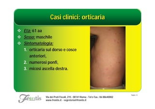 Casi clinici: orticaria
 Età: 61 aa
 Sesso: maschile
 Sintomatologia:
  1. orticaria sul dorso e cosce
     anteriori,
  2. numerosi ponfi,
  3. micosi ascella destra.




                                                                                   Pagina: 13
               Via dei Prati Fiscali, 215 - 00141 Roma - Tel e Fax.: 06 88640002
               www.frontis.it - segreteria@frontis.it
 
