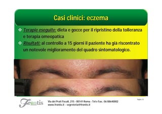 Casi clinici: eczema
 Terapie eseguite: dieta e gocce per il ripristino della tolleranza
  e terapia omeopatica
 Risultati: al controllo a 15 giorni il paziente ha già riscontrato
  un notevole miglioramento del quadro sintomatologico.




                                                                                    Pagina: 25
                Via dei Prati Fiscali, 215 - 00141 Roma - Tel e Fax.: 06 88640002
                www.frontis.it - segreteria@frontis.it
 