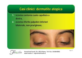Casi clinici: dermatite atopica
1. eczema contorno cuoio capelluto a
   destra,
2. eczema riferito palpebre inferiori
   bilaterale, non pruriginoso,




                                                                               Pagina: 43
           Via dei Prati Fiscali, 215 - 00141 Roma - Tel e Fax.: 06 88640002
           www.frontis.it - segreteria@frontis.it
 