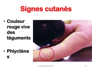 Signes cutanés
• Couleur
rouge vive
des
téguments
• Phlyctène
s
www.efurgences.net 12
 