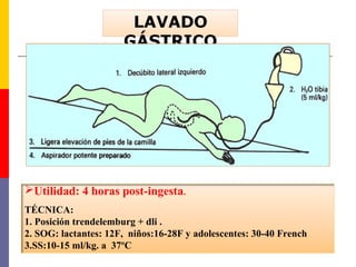 Utilidad: 4 horas post-ingesta.
TÉCNICA:
1. Posición trendelemburg + dli .
2. SOG: lactantes: 12F, niños:16-28F y adolescentes: 30-40 French
3.SS:10-15 ml/kg. a 37ºC
 