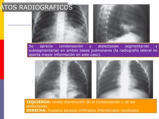 Se aprecia condensación y atelectasias segmentarias y
subsegmentarias en ambas bases pulmonares (la radiografía lateral no
aporta mayor información en este caso).
IZQUIERDA: revela disminución de la condensación y de las
atelectasias.
DERECHA: muestra escasos infiltrados intersticiales residuales.
ATOS RADIOGRAFICOS
 