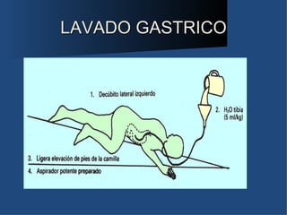 LAVADO GASTRICO
 