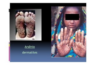 Arsênio 
dermatites 
 