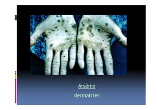 Arsênio 
dermatites 
 