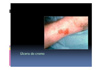 Úlcera do cromo 
 