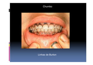 Chumbo 
Linhas de Burton 
 