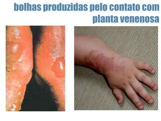 bolhas produzidas pelo contato com
planta venenosa
 