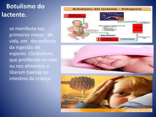 Botulismo do 
lactente. 
se manifesta nos 
primeiros meses de 
vida, em decorrência 
da ingestão de 
esporos Clostridium, 
que proliferam no solo 
ou nos alimentos e 
liberam toxinas no 
intestino da criança. 
 