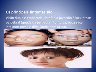 Os principais sintomas são: 
Visão dupla e embaçada, fotofobia (aversão à luz), ptose 
palpebral (queda da pálpebra), tonturas, boca seca, 
intestino preso e dificuldade para urinar. 
 