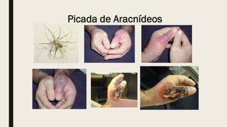 Picada de Aracnídeos
 