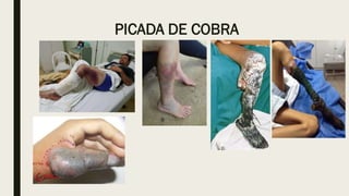 PICADA DE COBRA
 