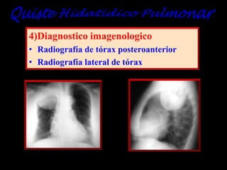 4)Diagnostico imagenologico
• Radiografía de tórax posteroanterior
• Radiografía lateral de tórax

 