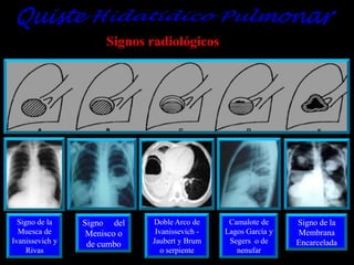 Signos radiológicos

Signo de la
Muesca de
Ivanissevich y
Rivas

Signo del
Menisco o
de cumbo

Doble Arco de
Ivanissevich Jaubert y Brum
o serpiente

Camalote de
Lagos García y
Segers o de
nenufar

Signo de la
Membrana
Encarcelada

 