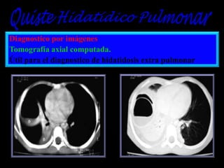 Diagnostico por imágenes
Tomografía axial computada.
Útil para el diagnostico de hidatidosis extra pulmonar

 