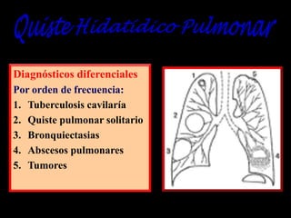 Diagnósticos diferenciales
Por orden de frecuencia:
1. Tuberculosis cavilaría
2. Quiste pulmonar solitario
3. Bronquiectasias
4. Abscesos pulmonares
5. Tumores

 
