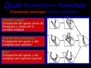 Tratamiento quirúrgico Técnicas quirúrgicas
Allende Langer
Extirpación del quiste cierre de
bronquios y sutura de la
cavidad residual
Velarde Pérez Fontana
Extirpación del quiste y del
complejo peri quístico
Brea
Extirpación del quiste y del
complejo peri quístico parcial

 