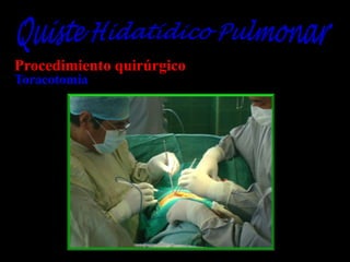 Procedimiento quirúrgico
Toracotomía

 