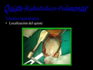 Técnica quirúrgica
• Localización del quiste

 