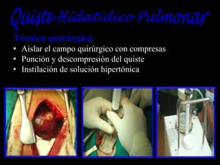 Técnica quirúrgica
• Aislar el campo quirúrgico con compresas
• Punción y descompresión del quiste
• Instilación de solución hipertónica

 